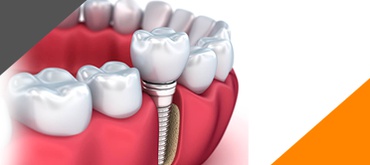 Pós Graduação: Especialização em Implantodontia com Ênfase em Cirurgia Virtual Guiada